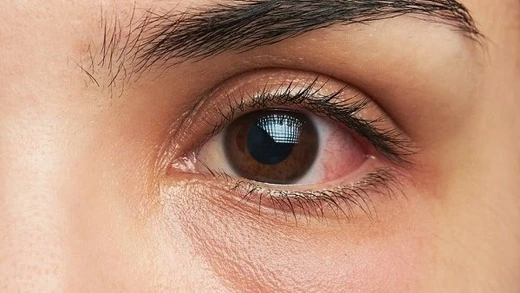 Human eye with redness