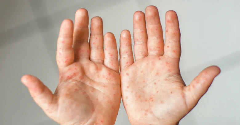 Hands with rash