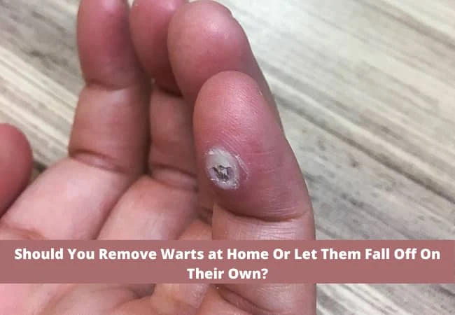 Human finger wart