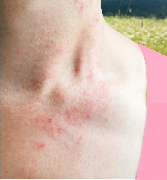 Red skin spots on neck and chest