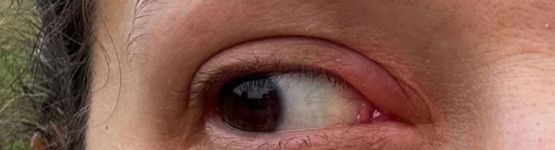 Zvětšený pohled na oko s červeným zánětem víčka.
