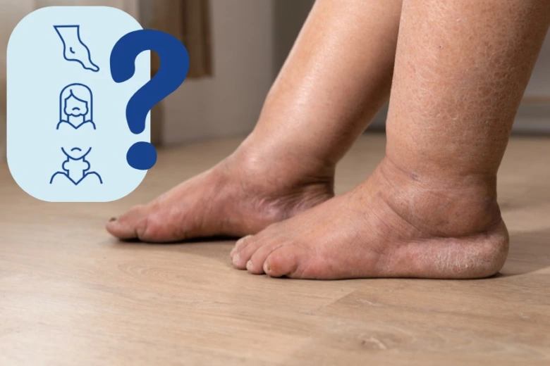Zvětšené nohy s otokem jako příznak angioedému.