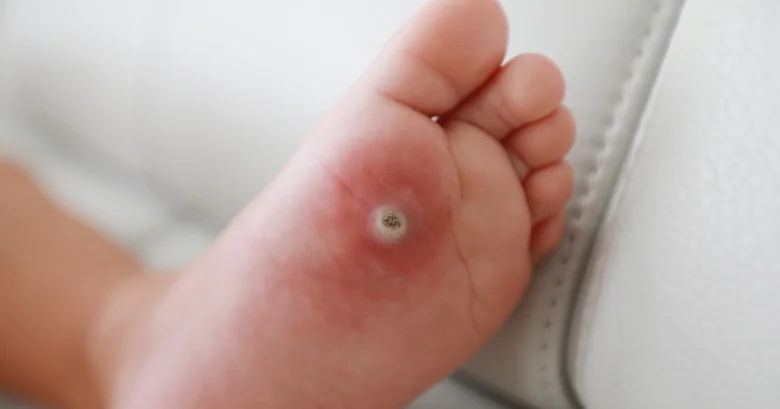 Zvětšený pohled na kuří oko s viditelným jádrem.