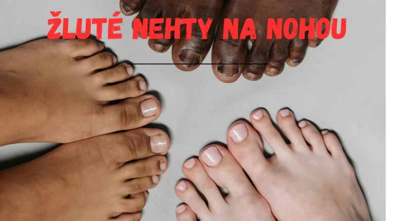 Žluté nehty na nohou u různých lidí