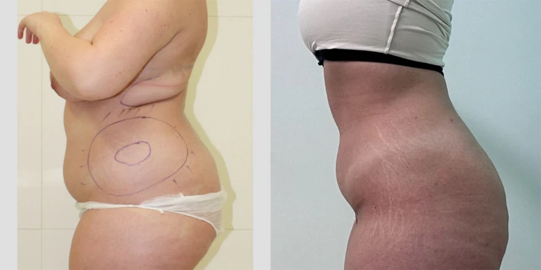 Porovnání před po liposukci břicha ukazuje výsledky operace.