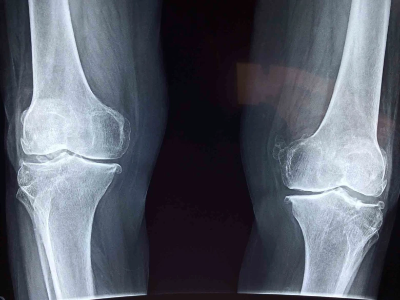 Knee joint x-ray