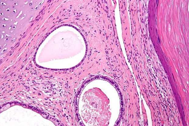 Histologický přípravek teratomu s tkáněmi v pojivové základně.