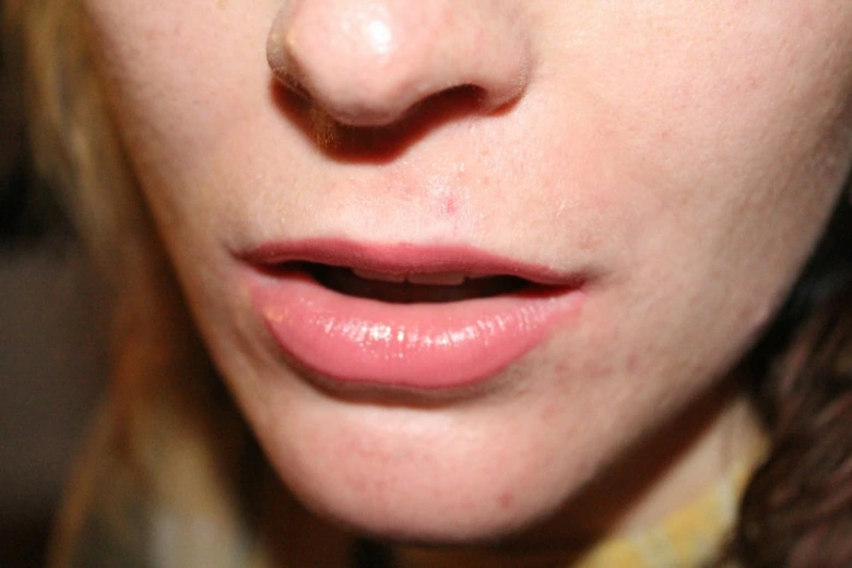 Swollen lips close-up