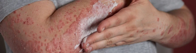 Červený lupusový vyrážka na kůži paže s aplikací krému.