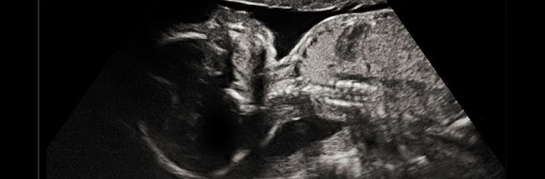 Ultrazvukové vyšetření plodu pro prenatální diagnostiku.