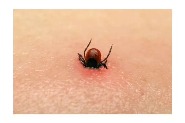 Klíště přisáté k lidské pokožce jako zdroj boreliózy.