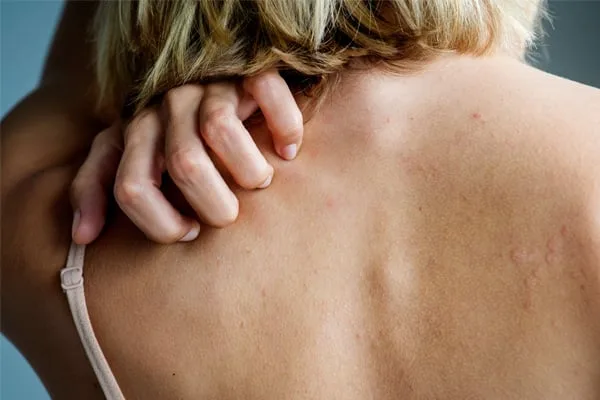 Woman scratching back skin