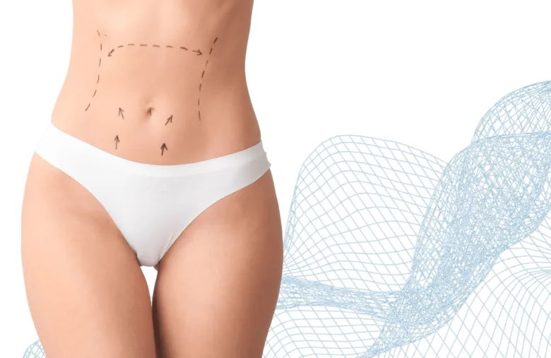 Označení pro chirurgickou lipoaspiraci břicha na těle ženy.