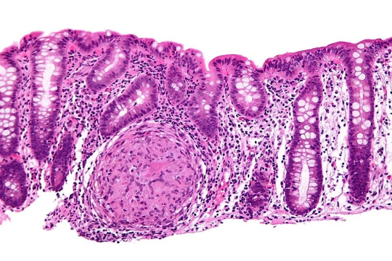 Crohn's disease histology