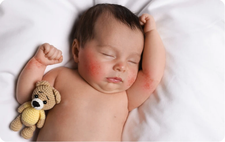 Sleeping baby with eczema rash