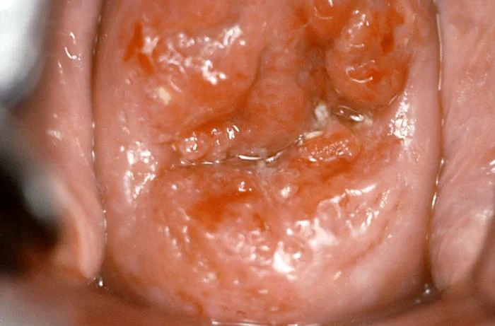 Zvětšený pohled na poškozenou sliznici úst dutiny způsobenou virem HPV.