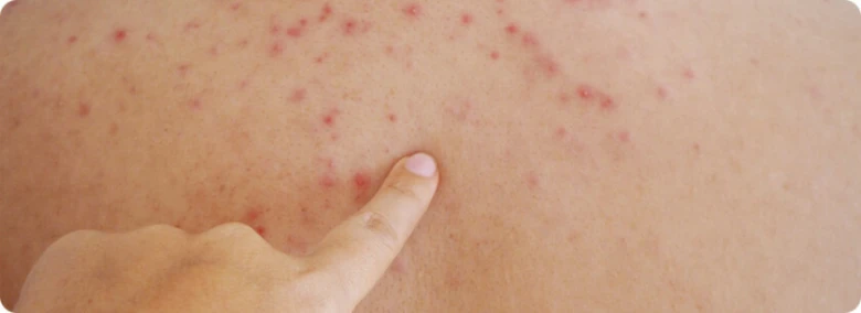 Červené vyrážky potniček na kůži dospělého ukazující příznaky.