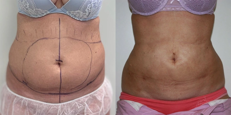 Předpozemní srovnání břicha před a po liposukci.