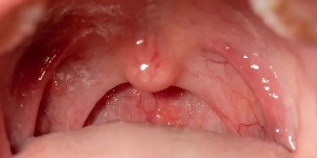 Swollen tonsils in throat