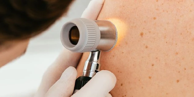 Dermatoskopie kůže při vyšetření znamének na zádech.
