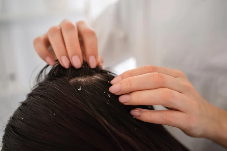 Dandruff on scalp