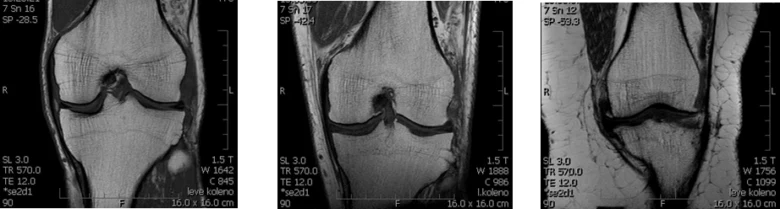 MRI snímek kolenního kloubu pro diagnostiku chondropatie.