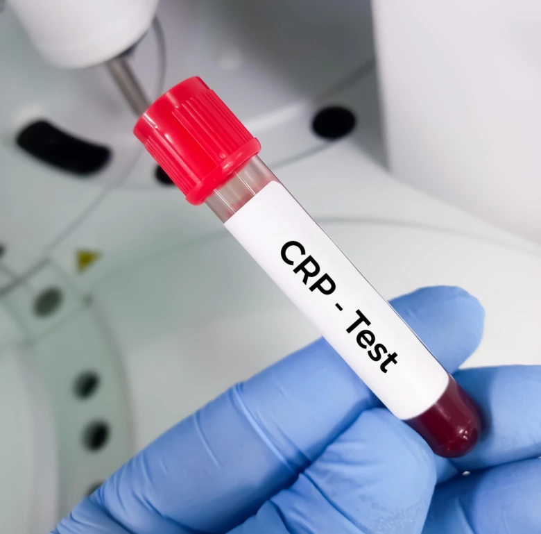 Krevní vzorek pro test CRP držený rukou s modrou rukavicí.