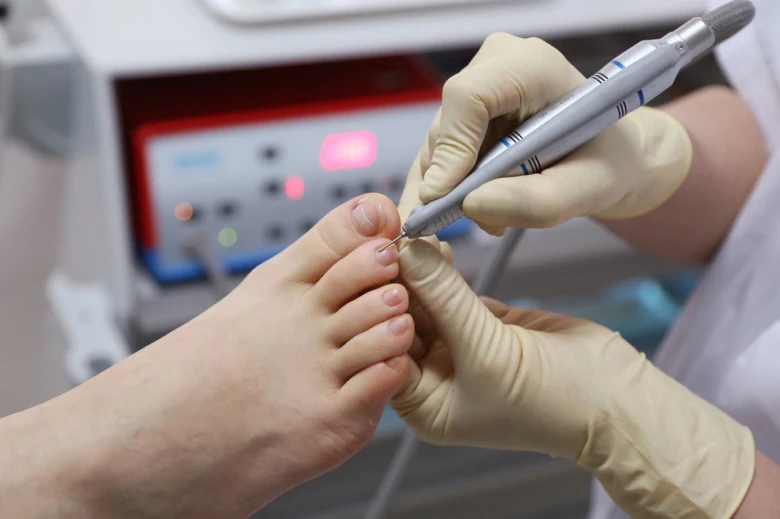 Pedicurista odstraňuje kuří oko na prstu rotačním pilníkem.