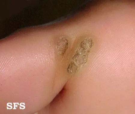 Plantar warts with roots