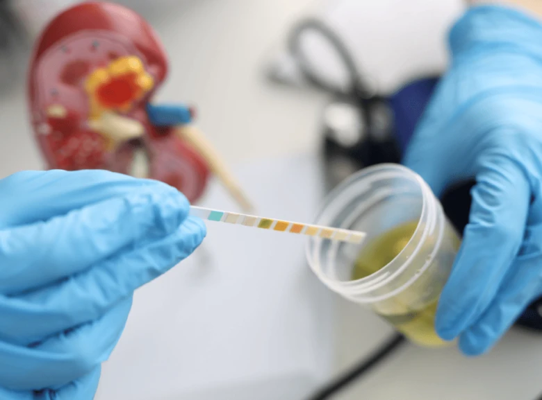 Testování moči pomocí proužku pro diagnostiku zvýšené kyseliny močové.