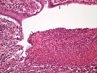 Histologický příznak zánětlivého střeva při Crohnově chorobě.