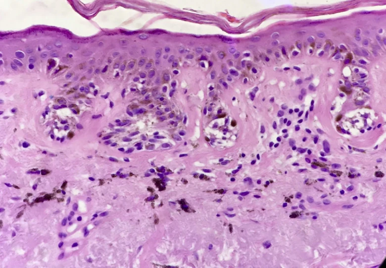Histologický přípravek kůže s pigmentací typickou pro solární lentiginózu.