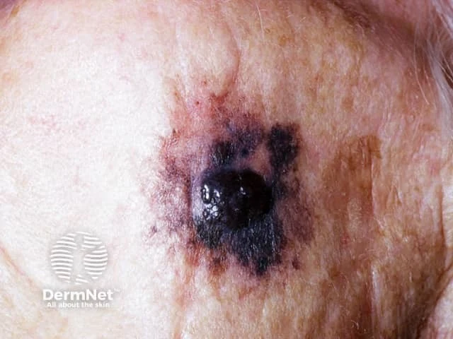 Fotografie tmavého pigmentovaného léze na kůži typické pro lentiginózní malignitu.