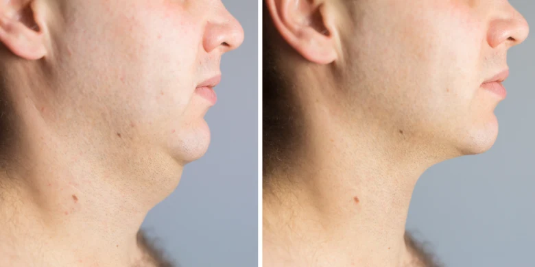 Male profile before after liposuction