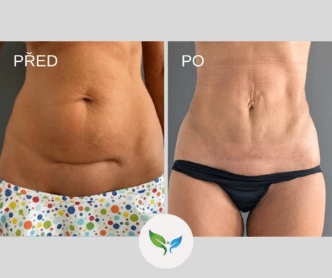 Liposuction before after