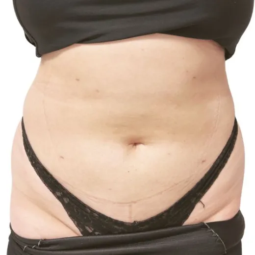 Předoperační značky na břiše pro liposukci.