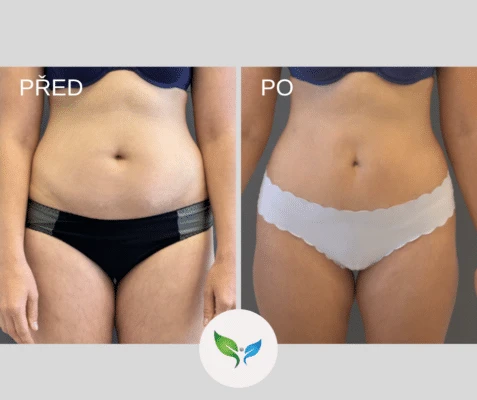 Porovnání břicha před a po liposukci u ženy