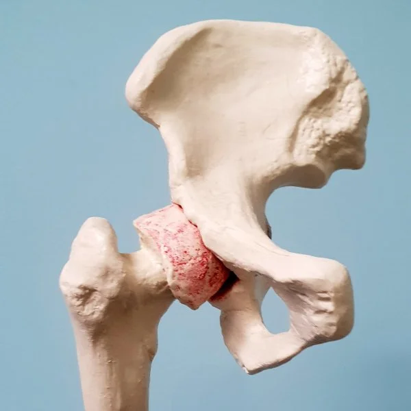 Anatomický model kyčle s poškozeným chrupavčitím tkání.