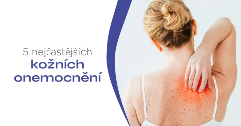 Woman scratching back rash