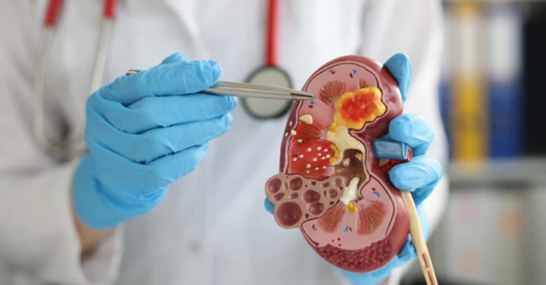 Anatomický model ledviny s patologiemi ukazuje příznaky bolesti.