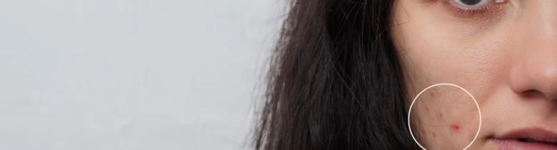 Woman's face with acne and eczema