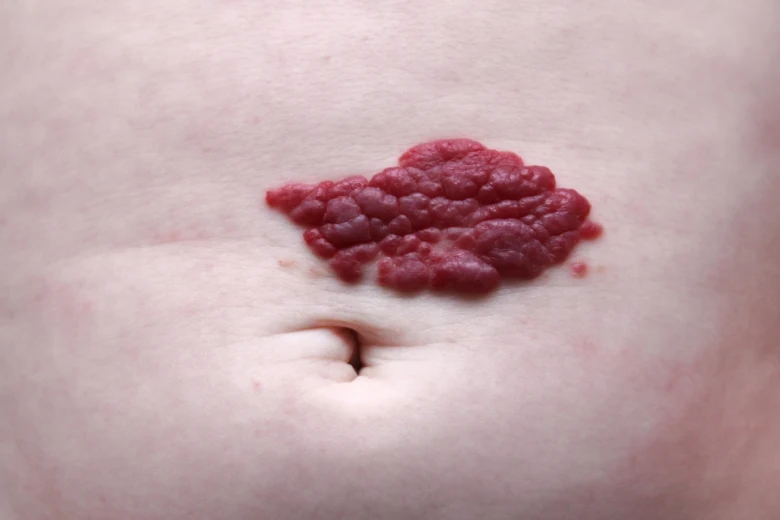 Infant hemangioma on skin