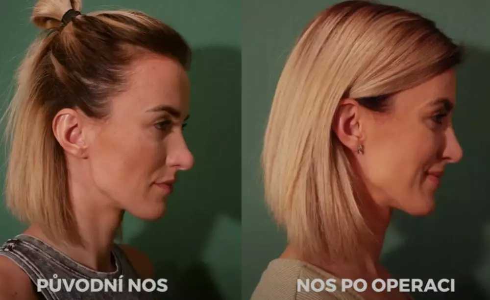 Žena s nosem před a po plastické operaci v profilu.