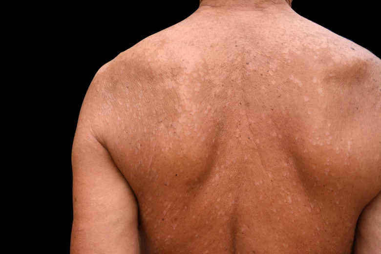 Pityriasis versicolor back