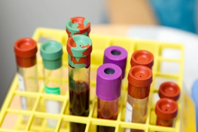 Krevní vzorky s barevnými uzávěry ve žlutém držáku pro laboratorní test.