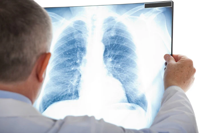 Lékař zkoumá rentgenový snímek plic pro diagnostiku zápalu.