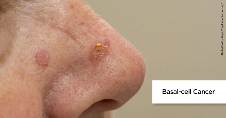 Bazaliom na kůži nosu s textem Basal-cell cancer