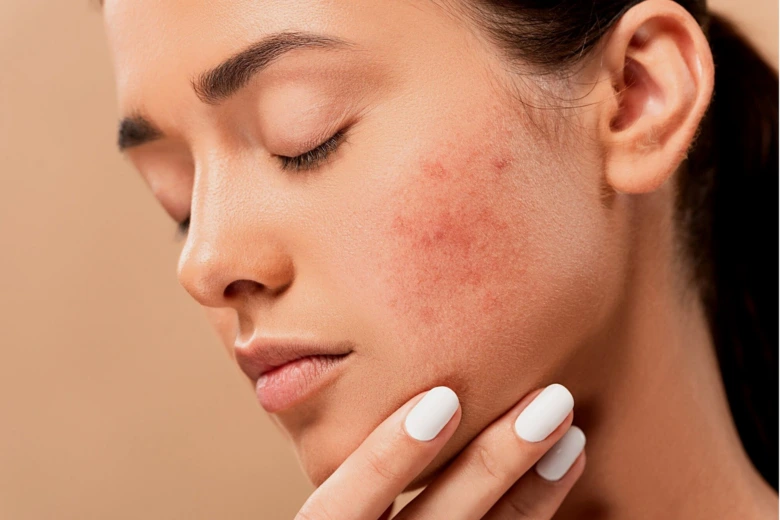 Woman with facial skin condition