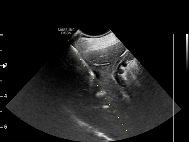 Ultrazvukové vyšetření jater pro diagnostiku fibrózy.