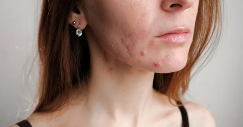 Žena s pupínky na bradě a v krku.